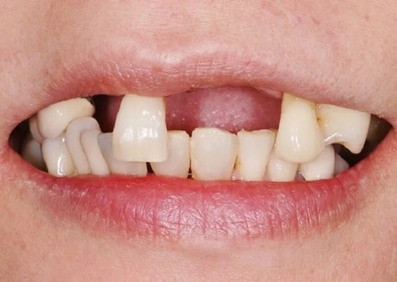 Mơ rụng nhiều răng có thể xuất hiện khi nhiều nguồn áp lực cùng tác động trong một thời điểm
